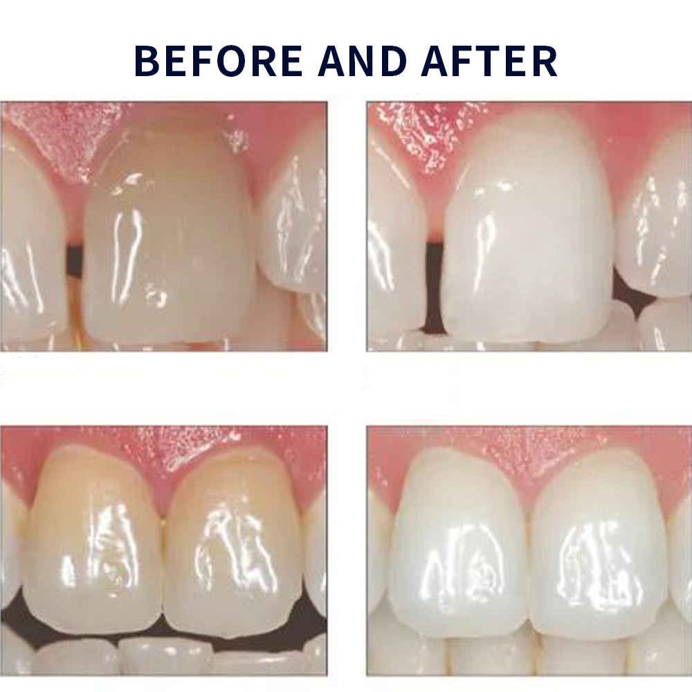 家庭用UV患者セット,プロの衛生機器,紫外線,16%,歯科材 - Teeth Whitening Shade Guide のレビューと価格