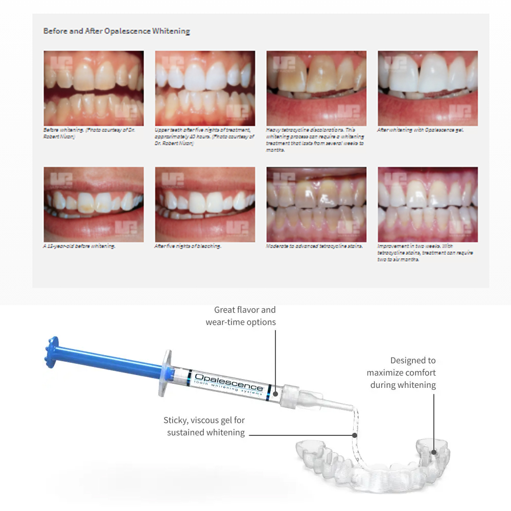 家庭用UV患者セット,プロの衛生機器,紫外線,16%,歯科材 - Teeth Whitening Shade Guide のレビューと価格