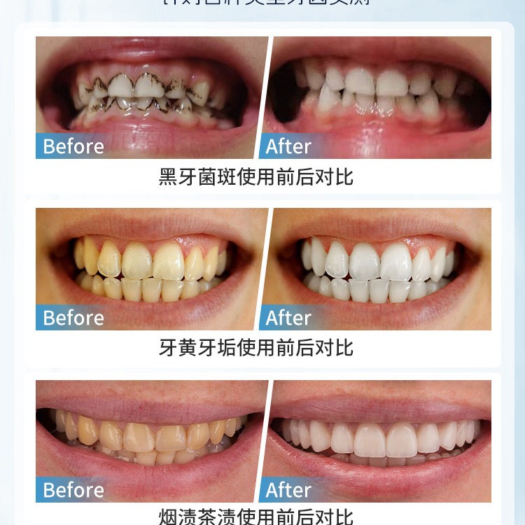 日本手動歯の汚れ除去ブラシポータブル歯垢除去口腔ディープクリ - Teeth Whitening Japan のレビューと価格